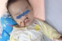 Cháu bé bỏng nặng vì mẹ nhỏ nhầm axit vào mũi