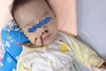 Cháu bé bỏng nặng vì mẹ nhỏ nhầm axit vào mũi