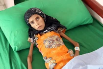 Xót xa bức ảnh bé gái da bọc xương và sự thật tàn khốc phía sau