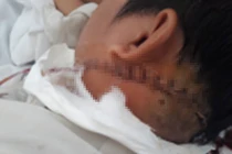 Cứu nam thanh niên bị chém đứt tĩnh mạch cổ