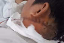 Cứu nam thanh niên bị chém đứt tĩnh mạch cổ