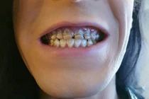 Chàng trai uống 6 chai nước tăng lực mỗi ngày và kết đắng