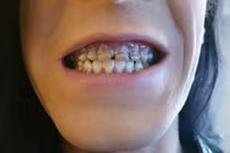 Chàng trai uống 6 chai nước tăng lực mỗi ngày và kết đắng