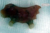 Răng giả “mọc” trong... thực quản