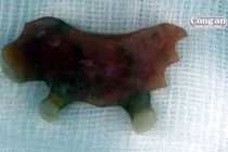 Răng giả “mọc” trong... thực quản