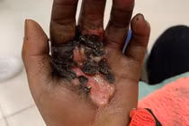 Căn bệnh khoảng 20% người Việt mắc nhưng hầu hết đều tự chữa