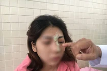 Cô gái 21 tuổi mù mắt sau khi tiêm filler nâng mũi