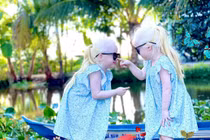 Cặp đôi song sinh mắc bệnh bạch tạng ở Sóc Trăng giờ ra sao?