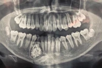 Thiếu niên phẫu thuật lấy ra gần 100 cái răng trong miệng