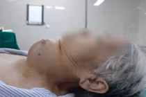 Tế bào ung thư sinh sôi suốt 50 năm trên cổ người phụ nữ