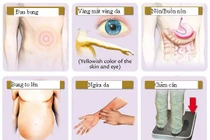 Ngứa liên tục có thể là dấu hiệu của căn bệnh ung thư có tỷ lệ mắc mới nhiều nhất tại Việt Nam