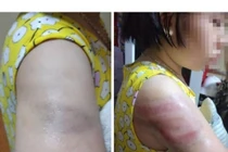 Sở GD&ĐT Nam Định đề nghị xử lý nghiêm cô giáo đánh tím tay học sinh