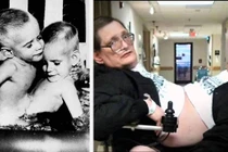 Cuộc sống của cặp sinh đôi dính liền sống cùng nhau lâu nhất TG