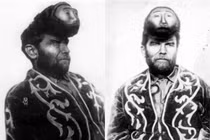 Cuộc đời của “dị nhân 2 đầu” đặc biệt nhất thế kỷ 20