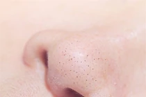 Trị mụn đầu đen hiệu quả không ngờ nhờ cơm nóng