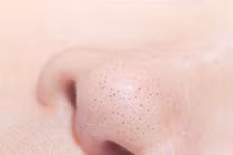 Trị mụn đầu đen hiệu quả không ngờ nhờ cơm nóng