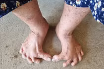 Giải mã bất ngờ về bàn chân Giao Chỉ của người Việt cổ