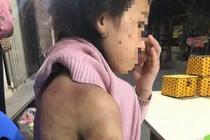 Bé gái 12 tuổi nghi bị bạo hành, xâm hại tình dục: Cục Trẻ em lên tiếng