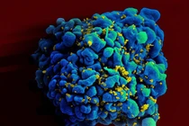 Phát hiện người thứ hai tự khỏi HIV
