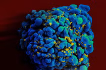 Phát hiện người thứ hai tự khỏi HIV