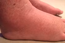 Bất ngờ phát hiện ung thư sau 1 lần tẩy lông