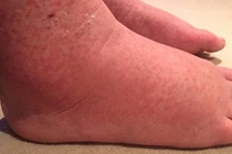 Bất ngờ phát hiện ung thư sau 1 lần tẩy lông