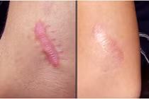 Bài thuốc trị sẹo lồi do bỏng hiệu quả