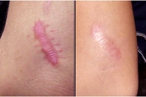 Bài thuốc trị sẹo lồi do bỏng hiệu quả