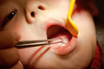 Bé gái suýt mất mạng vì cô giáo cố lôi thìa hóc ở cổ họng