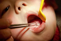 Bé gái suýt mất mạng vì cô giáo cố lôi thìa hóc ở cổ họng