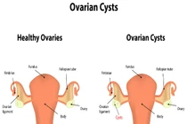 U nang buồng trứng tự triệt tiêu với mẹo dễ thực hiện