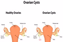 U nang buồng trứng tự triệt tiêu với mẹo dễ thực hiện