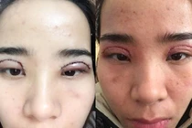 Biến chứng nguy hiểm khi cắt mí ở Spa không phép