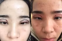 Biến chứng nguy hiểm khi cắt mí ở Spa không phép