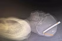 Bị xiên nguyên gậy bi-a xuyên đầu mà không chết