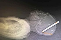 Bị xiên nguyên gậy bi-a xuyên đầu mà không chết