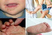 Cảnh báo dịch tay chân miệng bùng phát sau Tết