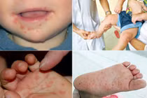 Cảnh báo dịch tay chân miệng bùng phát sau Tết