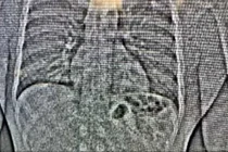 Tên trộm nuốt trang sức trị giá hơn 19 tỷ khi bị truy đuổi