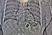 Tên trộm nuốt trang sức trị giá hơn 19 tỷ khi bị truy đuổi