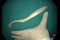 Nhiều người nhập viện vì nuốt bàn chải đánh răng: Bác sĩ khuyến cáo gì?