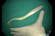 Nhiều người nhập viện vì nuốt bàn chải đánh răng: Bác sĩ khuyến cáo gì?