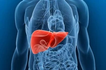 Dáng đi cảnh báo bệnh gan nhiễm mỡ tiến triển nặng