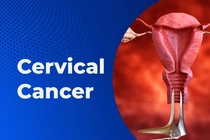 Ung thư cổ tử cung gây tử vong: Ai dễ mắc bệnh hơn?