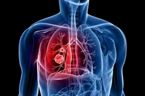 Đau chân tưởng thấp khớp, ai ngờ mắc ung thư phổi