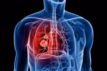 Đau chân tưởng thấp khớp, ai ngờ mắc ung thư phổi