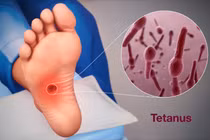 Vi khuẩn uốn ván sản sinh độc tố nguy hiểm sao?