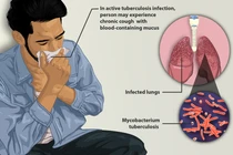 Bệnh lao gây tử vong: Ai có nguy cơ mắc cao hơn?