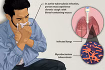 Bệnh lao gây tử vong: Ai có nguy cơ mắc cao hơn?