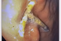 Dụng cụ tránh thai đi lạc, xuyên qua dạ dày người phụ nữ